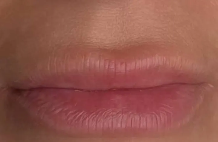 Antes: Micropigmentación de labios.